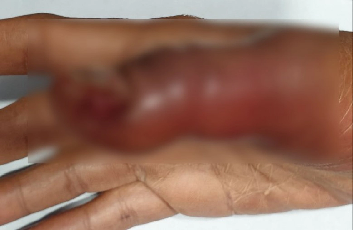 สาวต่อเล็บติดเชื้อที่นิ้วบวมเป่งลามถึงกระดูกหวั่นติด HIV ซ้ำ