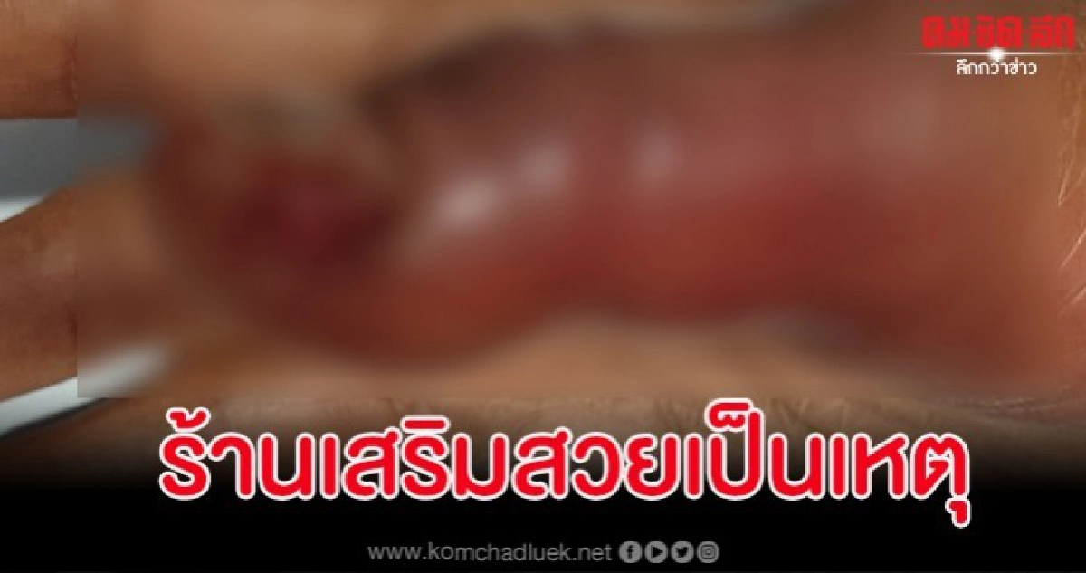 สาวต่อเล็บติดเชื้อที่นิ้วบวมเป่งลามถึงกระดูกหวั่นติด HIV ซ้ำ