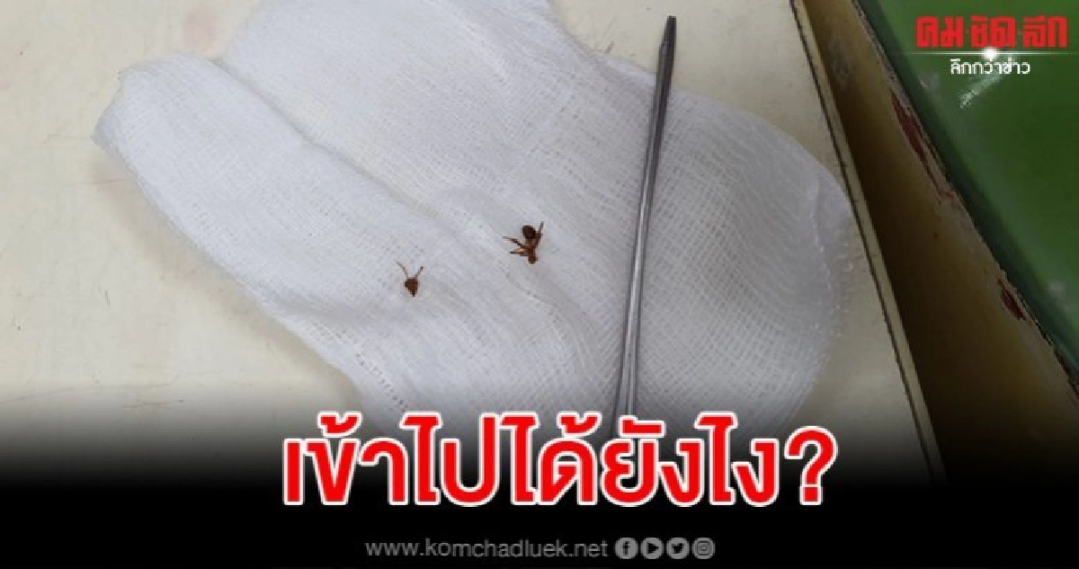 หมองงหนักมาก คนไข้นึกว่าก้างติดคอพอส่องดูเจอมดกัดลิ้นไก่ หมองงหนักมาก คนไข้นึกว่าก้างติดคอพอส่องดูเจอมดกัดลิ้นไก่