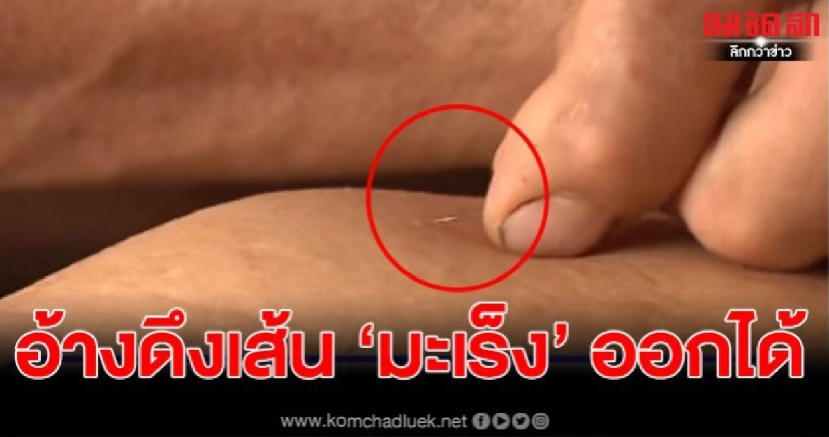 หมอเตือน อย่าหลงเชื่อ 'หมอดึงมะเร็ง' แล้วหาย มันไม่จริง หมอเตือน อย่าหลงเชื่อ 'หมอดึงมะเร็ง' แล้วหาย มันไม่จริง
