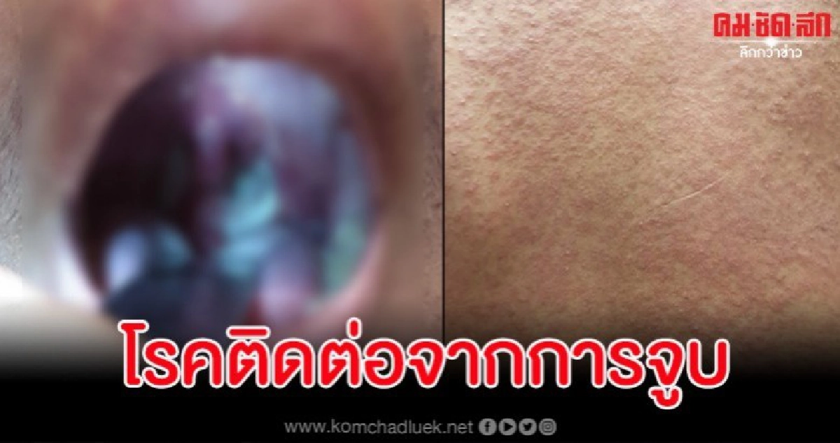 อุทาหรณ์ หนุ่มวัย 15 จูบกับแฟนสาวสุดท้ายติดเชื้อ ผื่นเต็มตัว อุทาหรณ์ หนุ่มวัย 15 จูบกับแฟนสาวสุดท้ายติดเชื้อ ผื่นเต็มตัว