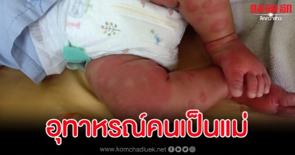 คุณแม่ปวดใจลูกติดเชื้อไวรัสที่มากับอากาศ ตุ่มแดงลามเต็มตัว คุณแม่ปวดใจลูกติดเชื้อไวรัสที่มากับอากาศ ตุ่มแดงลามเต็มตัว
