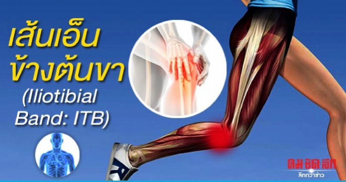 เส้นเอ็นข้างต้นขา (Iliotibial Band: ITB)