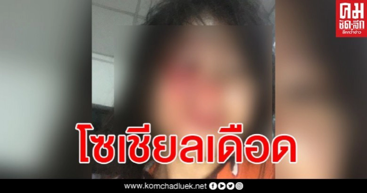 ช่วยด้วย สาวโพสต์สภาพใบหน้าสุดยับเยิน ระบุ "โดนพ่อของลูกตี" ช่วยด้วย สาวโพสต์สภาพใบหน้าสุดยับเยิน ระบุ "โดนพ่อของลูกตี"