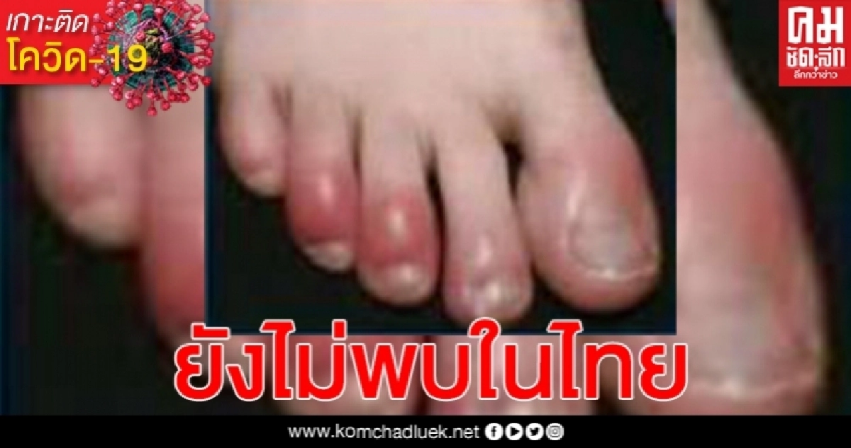 กรมควบคุมโรค เผยไทยเฝ้าระวังและติดตามรอยโรคผิวหนังบริเวณนิ้วเท้าที่พบในผู้ป่วยโรคโควิด-19 