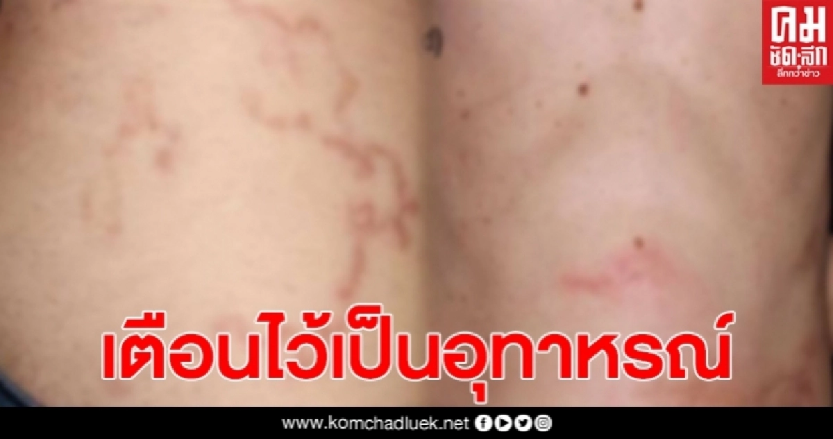 ผู้ป่วย 2 รายติดพยาธิตัวจี๊ด หลังกินซาชิมิปลาเงิน