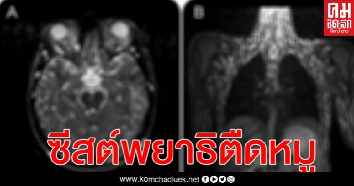กระจายเต็มตัว! กินผักสด ผลไม้ น้ำไม่สะอาด ระวัง"ไข่พยาธิตืดหมู" กระจายเต็มตัว! กินผักสด ผลไม้ น้ำไม่สะอาด ระวัง"ไข่พยาธิตืดหมู"