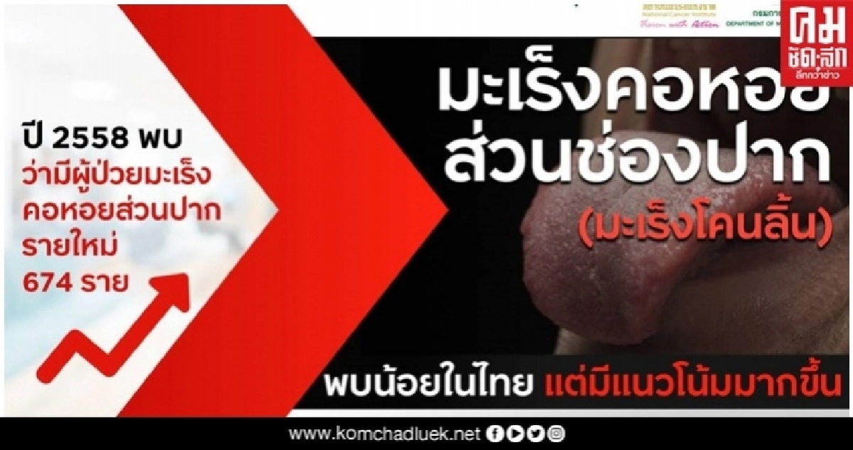 สถาบันมะเร็งแห่งชาติ ชี้มะเร็งโคนลิ้น พบได้น้อย แต่มีแนวโน้มมากขึ้น