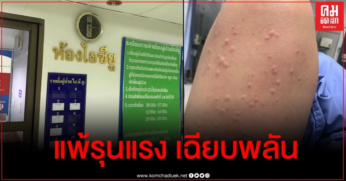 สาวเล่าประสบการณ์เฉียดตาย หลังแพ้รุนแรง เฉียบพลัน สาวเล่าประสบการณ์เฉียดตาย หลังแพ้รุนแรง เฉียบพลัน