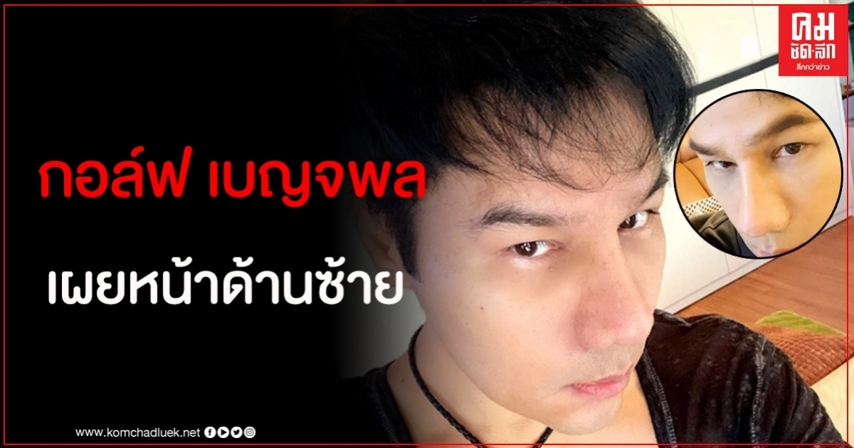 กอล์ฟ เบญจพล ขอบคุณทุกกำลังใจพร้อมเผยหน้าซีกซ้ายบอก "รออีกนิด" กอล์ฟ เบญจพล ขอบคุณทุกกำลังใจพร้อมเผยหน้าซีกซ้ายบอก "รออีกนิด"