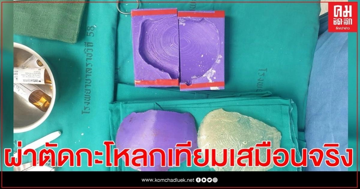 รพ.ราชวิถี ผ่าตัดกะโหลกเทียมเสมือนจริง ด้วยพิมพ์ 3D รพ.ราชวิถี ผ่าตัดกะโหลกเทียมเสมือนจริง ด้วยพิมพ์ 3D