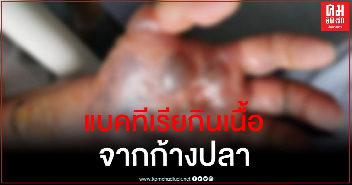 ชายจีนติดแบคทีเรียกินเนื้อ ก้างตำนิ้วขณะล้างปลา คิดว่าไม่เป็นอะไรปล่อยจนเกือบสาย ชายจีนติดแบคทีเรียกินเนื้อ ก้างตำนิ้วขณะล้างปลา คิดว่าไม่เป็นอะไรปล่อยจนเกือบสาย