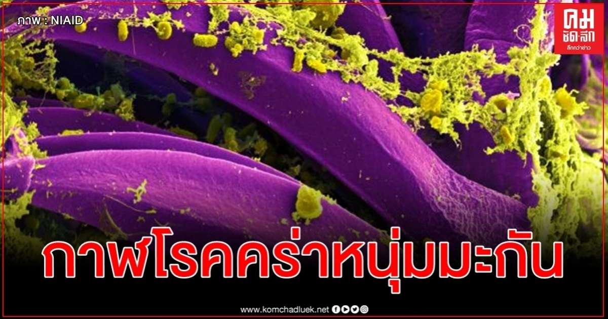  กาฬโรคคร่าชีวิตหนุ่มมะกันในรัฐนิวเม็กซิโก รายแรกในรอบ 5 ปี 
