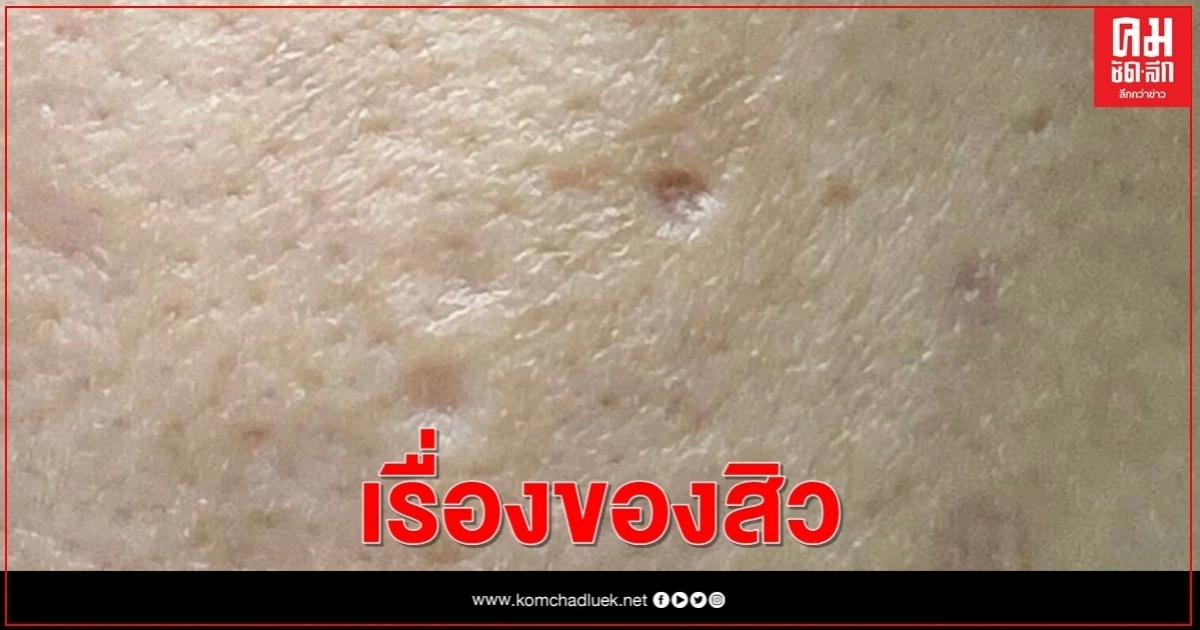 เรื่องของสิว ทำไมต้องรักษา เรื่องของสิว ทำไมต้องรักษา