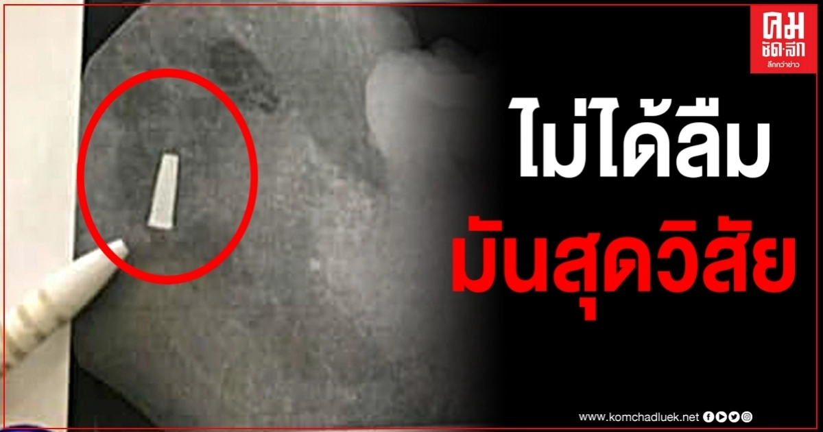 ทันตแพทยสภาโร่แจงปม หัวกรอฟันติดเหงือกคนไข้ 5 ปี ลั่นไม่ได้ลืม แต่มันสุดวิสัย ทันตแพทยสภาโร่แจงปม หัวกรอฟันติดเหงือกคนไข้ 5 ปี ลั่นไม่ได้ลืม แต่มันสุดวิสัย