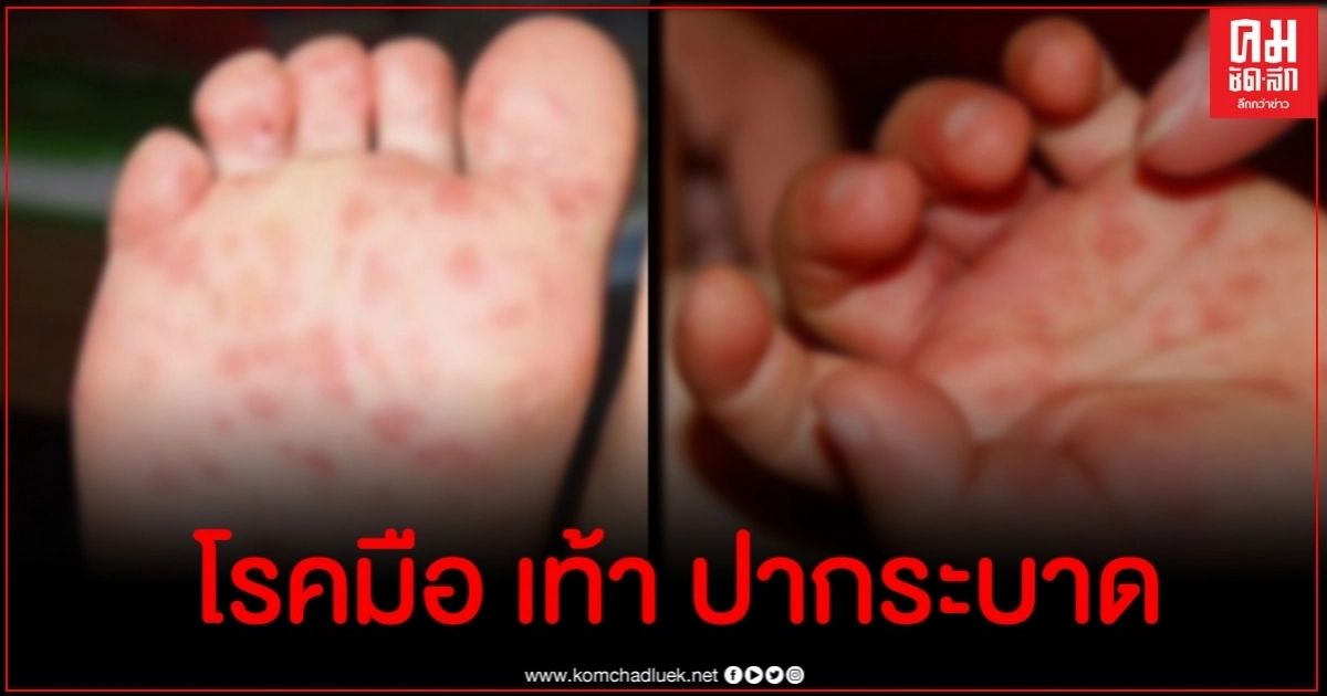 พบโรคมือ เท้า ปาก ระบาดที่ยะลา พบโรคมือ เท้า ปาก ระบาดที่ยะลา