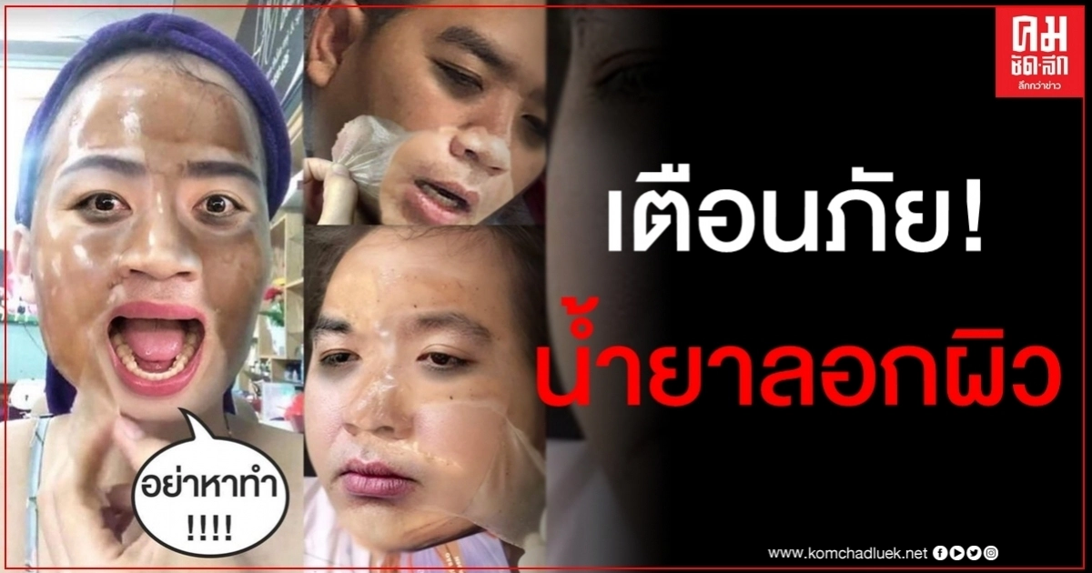 "หมอแล็บ" เตือนภัย "น้ำยาลอกผิวขาว" สุดอันตราย ซ้ำร้ายเสี่ยงเป็นมะเร็งผิวหนัง "หมอแล็บ" เตือนภัย "น้ำยาลอกผิวขาว" สุดอันตราย ซ้ำร้ายเสี่ยงเป็นมะเร็งผิวหนัง