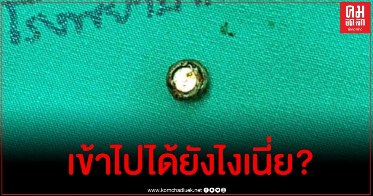 พบแบตเตอรี่นาฬิกาในจมูกหนูน้อย 3 ขวบ คาดเข้าไปไม่ต่ำกว่า 7 วัน พบแบตเตอรี่นาฬิกาในจมูกหนูน้อย 3 ขวบ คาดเข้าไปไม่ต่ำกว่า 7 วัน