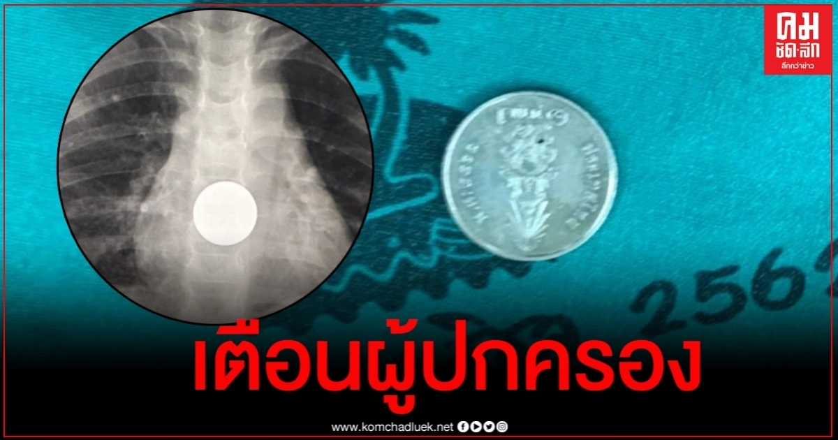 อุทาหรณ์ หนูน้อย 2 ขวบกลืนเหรียญลงคอ หลังผู้ปกครองปล่อยให้อยู่ลำพัง อุทาหรณ์ หนูน้อย 2 ขวบกลืนเหรียญลงคอ หลังผู้ปกครองปล่อยให้อยู่ลำพัง