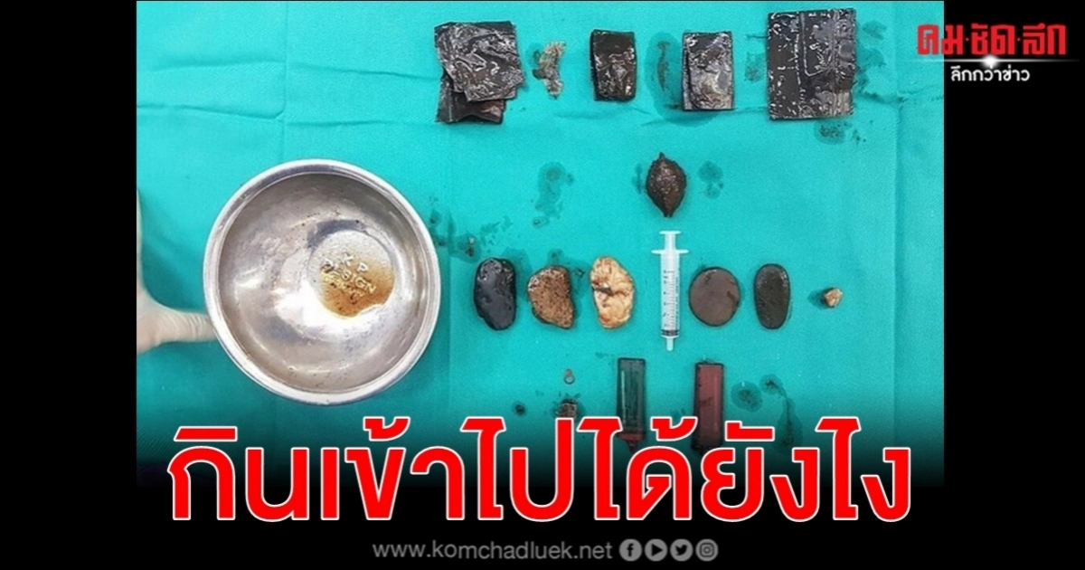 หมอเวียดนามผงะเจอไฟแช็ก หลอดฉีดยา พลาสติก ก้อนหินในท้องคนไข้ หมอเวียดนามผงะเจอไฟแช็ก หลอดฉีดยา พลาสติก ก้อนหินในท้องคนไข้