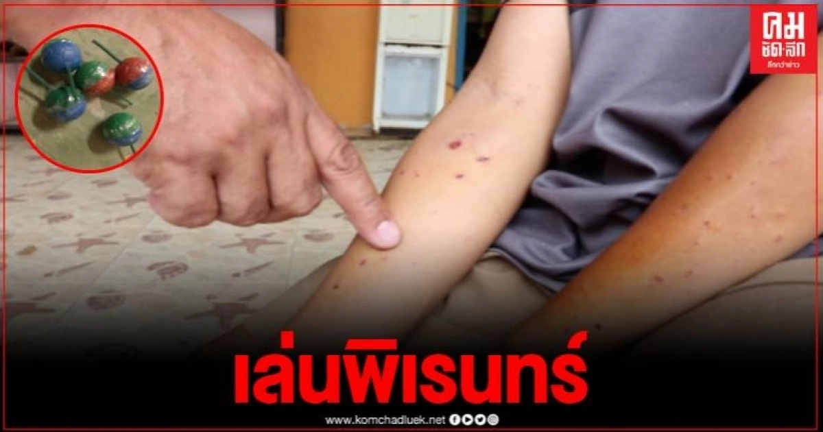 อุทาหรณ์ เด็ก 12 ปี จุดประทัดยัดขวดแก้ว คิดว่าชนวนดับย้อนมาเก็บ ตูมสนั่นคามือ อุทาหรณ์ เด็ก 12 ปี จุดประทัดยัดขวดแก้ว คิดว่าชนวนดับย้อนมาเก็บ ตูมสนั่นคามือ