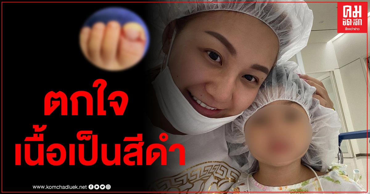 "เอ็ม บุษราคัม" เผยวินาทีหมอแกะแผลน้อง "นาฬิกา" ออก ตกใจมาก เนื้อตรงนั้นกลายเป็นสีดำ "เอ็ม บุษราคัม" เผยวินาทีหมอแกะแผลน้อง "นาฬิกา" ออก ตกใจมาก เนื้อตรงนั้นกลายเป็นสีดำ