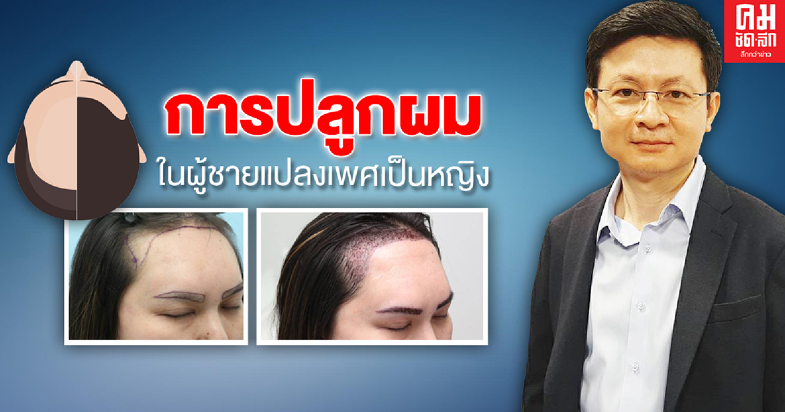การปลูกผมในผู้ชายแปลงเพศเป็นหญิง