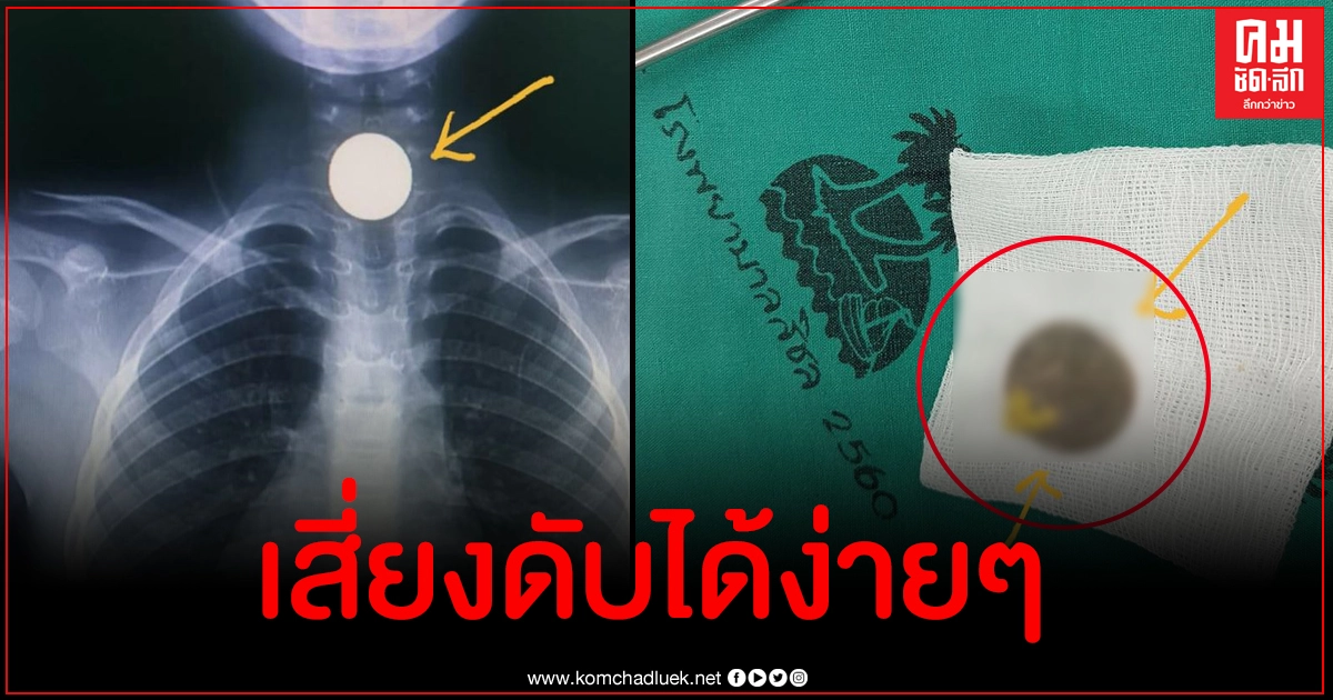 โผล่อีก เด็กชาย 6 ขวบกลืนเหรียญ 5 บาทลงคอ โผล่อีก เด็กชาย 6 ขวบกลืนเหรียญ 5 บาทลงคอ