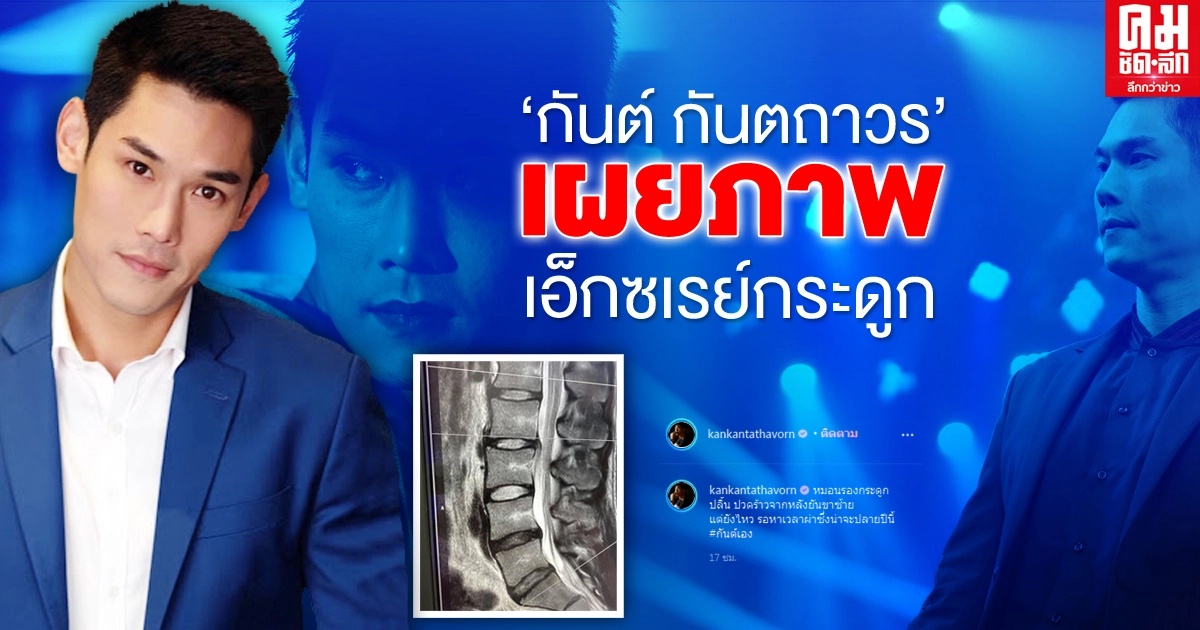 "กันต์ กันตถาวร" โพสต์รูปภาพฟิล์มเอกซเรย์กระดูก อาการปวดร้าวจากหลังยันขาซ้าย ลั่นรอหาเวลาผ่า "กันต์ กันตถาวร" โพสต์รูปภาพฟิล์มเอกซเรย์กระดูก อาการปวดร้าวจากหลังยันขาซ้าย ลั่นรอหาเวลาผ่า