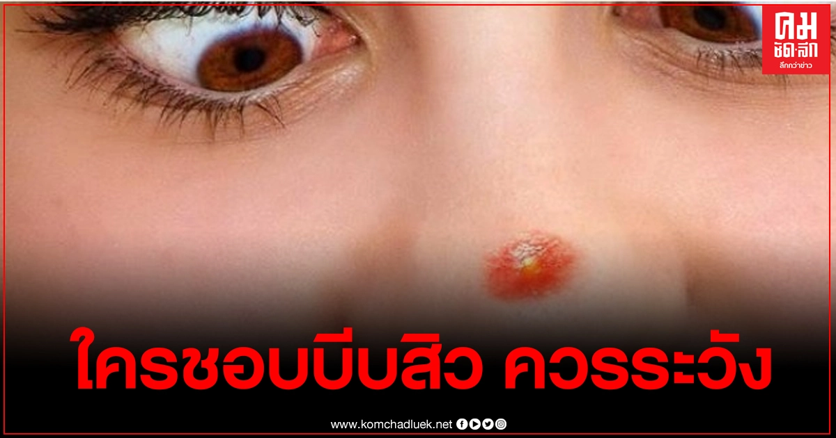 หมอแล็บแพนด้า เผย บีบสิวปลายจมูกเสี่ยงติดเชื้อในสมอง หมอแล็บแพนด้า เผย บีบสิวปลายจมูกเสี่ยงติดเชื้อในสมอง