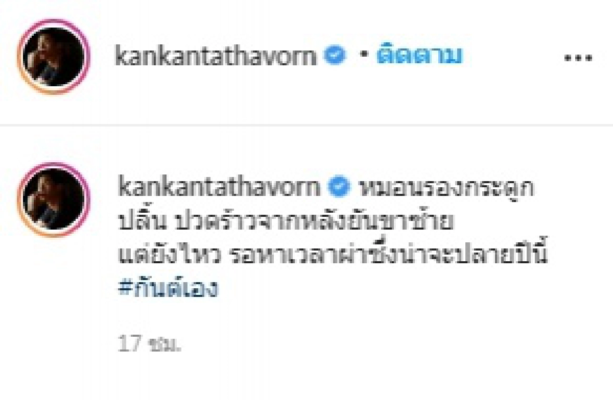 "กันต์ กันตถาวร" โพสต์รูปภาพฟิล์มเอกซเรย์กระดูก อาการปวดร้าวจากหลังยันขาซ้าย ลั่นรอหาเวลาผ่า