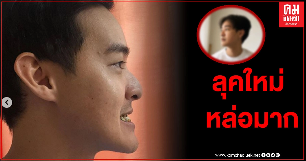 "หม่อมเอ็ม" อัพเดตหน้า หลังผ่าตัดขากรรไกรครบ 1 ปี บอกเลยหล่อมาก แทบจำไม่ได้ "หม่อมเอ็ม" อัพเดตหน้า หลังผ่าตัดขากรรไกรครบ 1 ปี บอกเลยหล่อมาก แทบจำไม่ได้