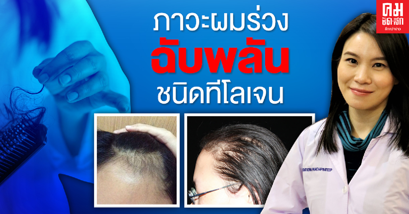 ภาวะผมร่วงฉับพลันชนิดทีโลเจน Telogen Effluvium (TE)