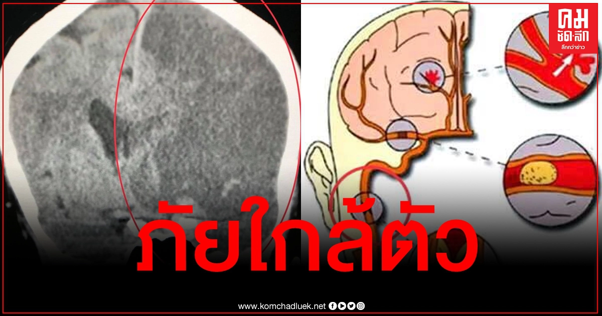 ภัยใกล้ตัว "หมอมนูญ" เตือน "โรคหลอดเลือดสมอง" ชี้รักษาทันลดตาย-พิการได้ ภัยใกล้ตัว "หมอมนูญ" เตือน "โรคหลอดเลือดสมอง" ชี้รักษาทันลดตาย-พิการได้