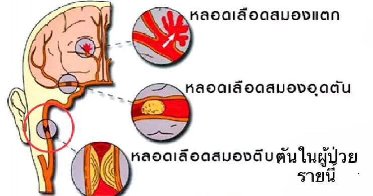 โรคหลอดเลือดสมอง