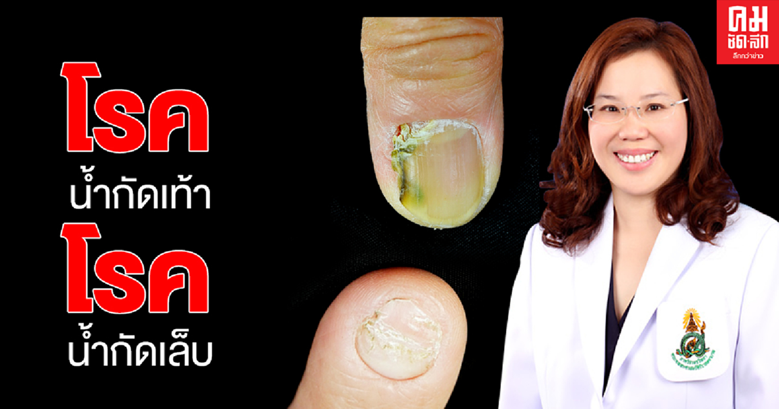 โรคน้ำกัดเท้า โรคน้ำกัดเล็บ