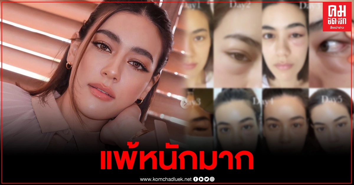ดูแลตัวเองกันด้วย "คิมเบอร์ลี่" เผยภาพตาบวมหนัก จากอากาศแพ้ฝุ่นPM2.5