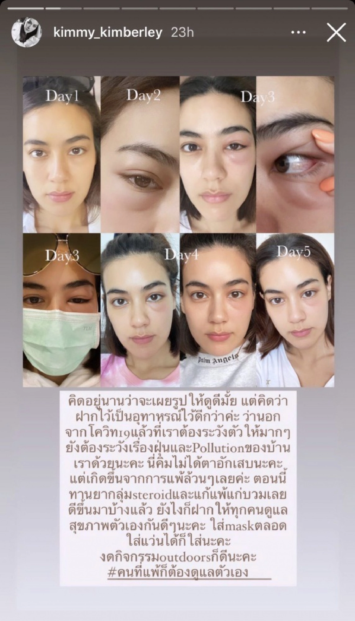 ดูแลตัวเองกันด้วย "คิมเบอร์ลี่" เผยภาพตาบวมหนัก จากอากาศแพ้ฝุ่นPM2.5