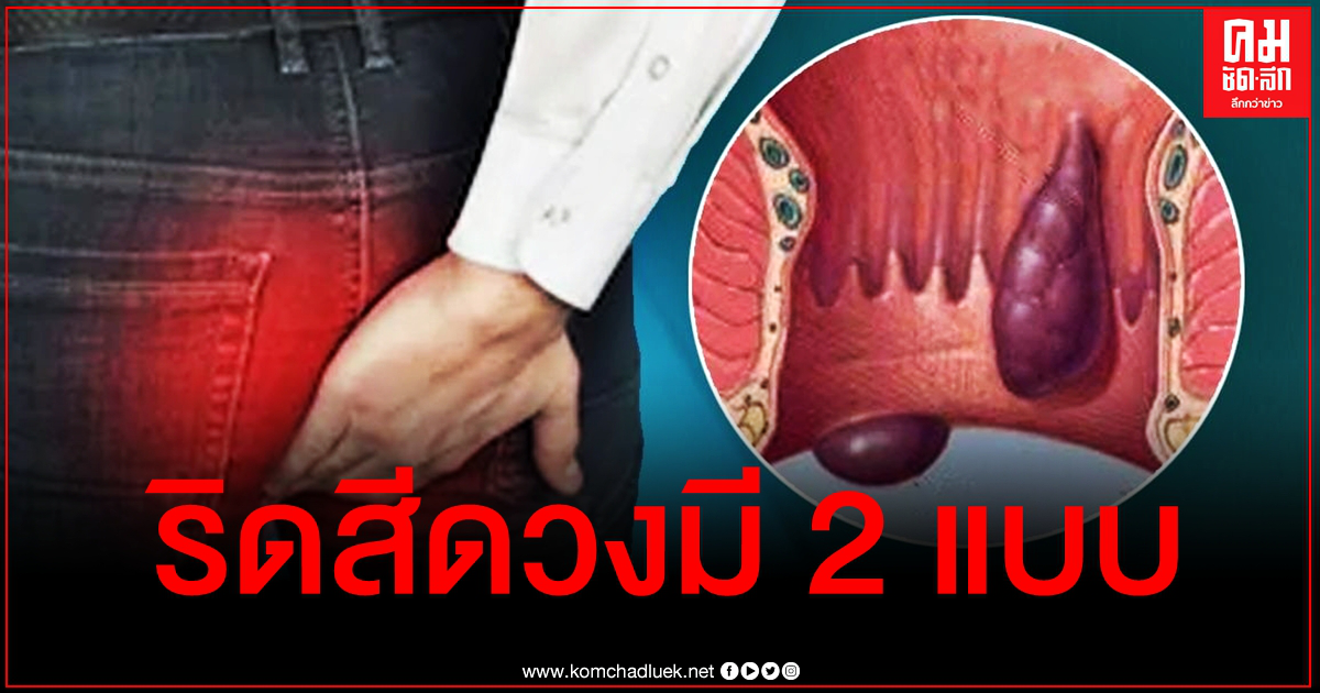ริดสีดวงทวารเลี่ยงได้ "หมอแล็บ" ชี้ง่ายๆแค่ปรับพฤติกรรมตามนี้ ริดสีดวงทวารเลี่ยงได้ "หมอแล็บ" ชี้ง่ายๆแค่ปรับพฤติกรรมตามนี้