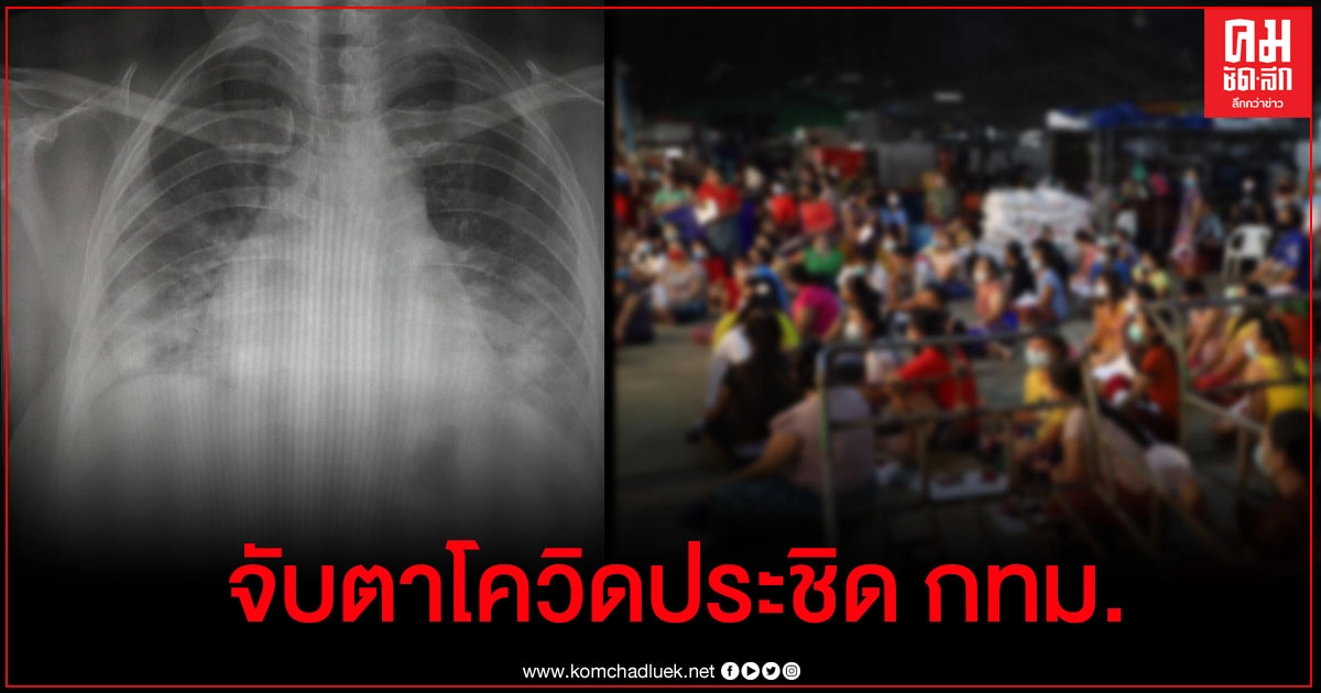 หมอเผยภาพเอกซเรย์ปอดคนไข้โควิด คาด 2-3 วันระบาดเป็นวงกว้าง หวั่นล็อกดาวน์ หมอเผยภาพเอกซเรย์ปอดคนไข้โควิด คาด 2-3 วันระบาดเป็นวงกว้าง หวั่นล็อกดาวน์