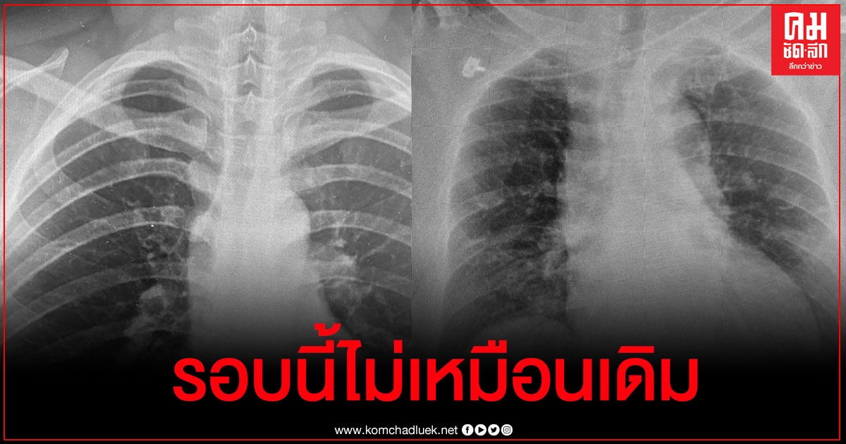 ภาพฟิล์มปอดผู้ป่วยโควิด-19 ไม่มีอาการแต่มีเชื้อพร้อมแพร่กระจายเยอะมาก แถมไปบ่อน กทม.มา ภาพฟิล์มปอดผู้ป่วยโควิด-19 ไม่มีอาการแต่มีเชื้อพร้อมแพร่กระจายเยอะมาก แถมไปบ่อน กทม.มา