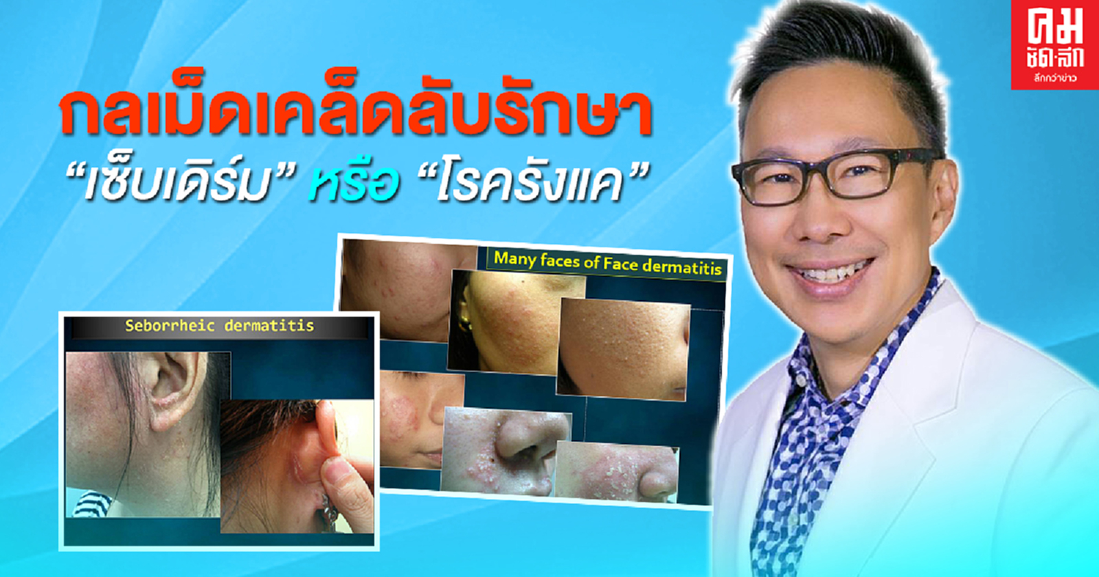 กลเม็ดเคล็ดลับรักษา"เซ็บเดิร์ม" หรือ "โรครังแค"  