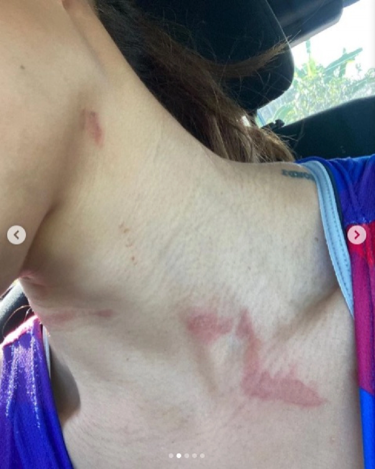 "โย ยศวดี" โดนพิษแมลงก้นกระดก แพ้หนักตัวเย็น อาเจียน3รอบ