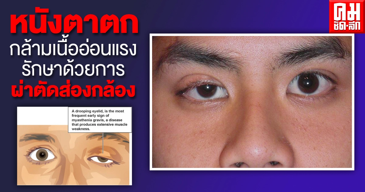 หนังตาตก..กล้ามเนื้ออ่อนแรงรักษาด้วยการผ่าตัดส่องกล้อง