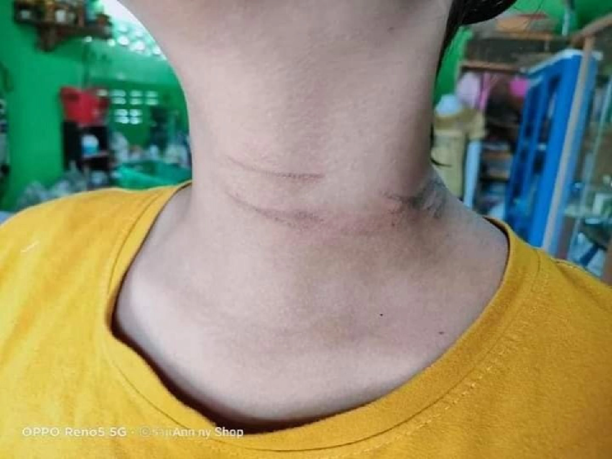 เตือนภัยวัยรุ่น ชาร์จมือถือบนที่นอนสร้อยโดนปลั๊ก ไฟช็อตคอจนเป็นรอยไหม้