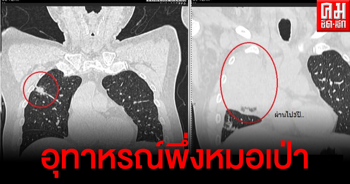 แชร์ไว้เป็นอุทาหรณ์ คนไข้ป่วย "มะเร็งขา" ไม่รักษาหวังพึ่งหมอเป่า สุดท้ายลามมาปอด แชร์ไว้เป็นอุทาหรณ์ คนไข้ป่วย "มะเร็งขา" ไม่รักษาหวังพึ่งหมอเป่า สุดท้ายลามมาปอด
