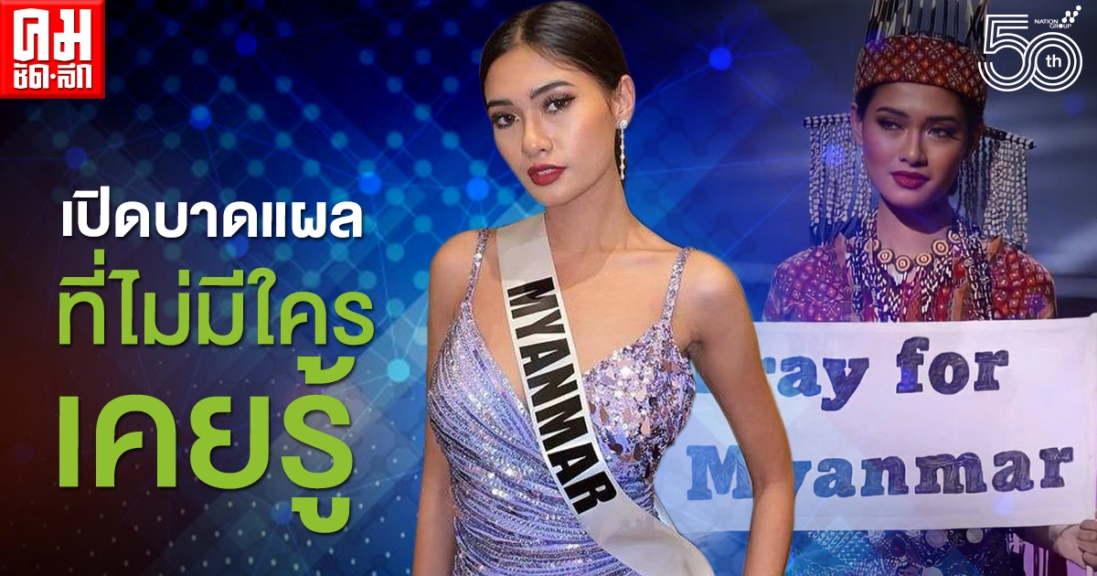 ไม่อาย "Thuzar Wint Lwin" มิสยูนิเวิร์สพม่า 2020 เปิดรอยแผลจากการผ่าตัด ไม่อาย "Thuzar Wint Lwin" มิสยูนิเวิร์สพม่า 2020 เปิดรอยแผลจากการผ่าตัด
