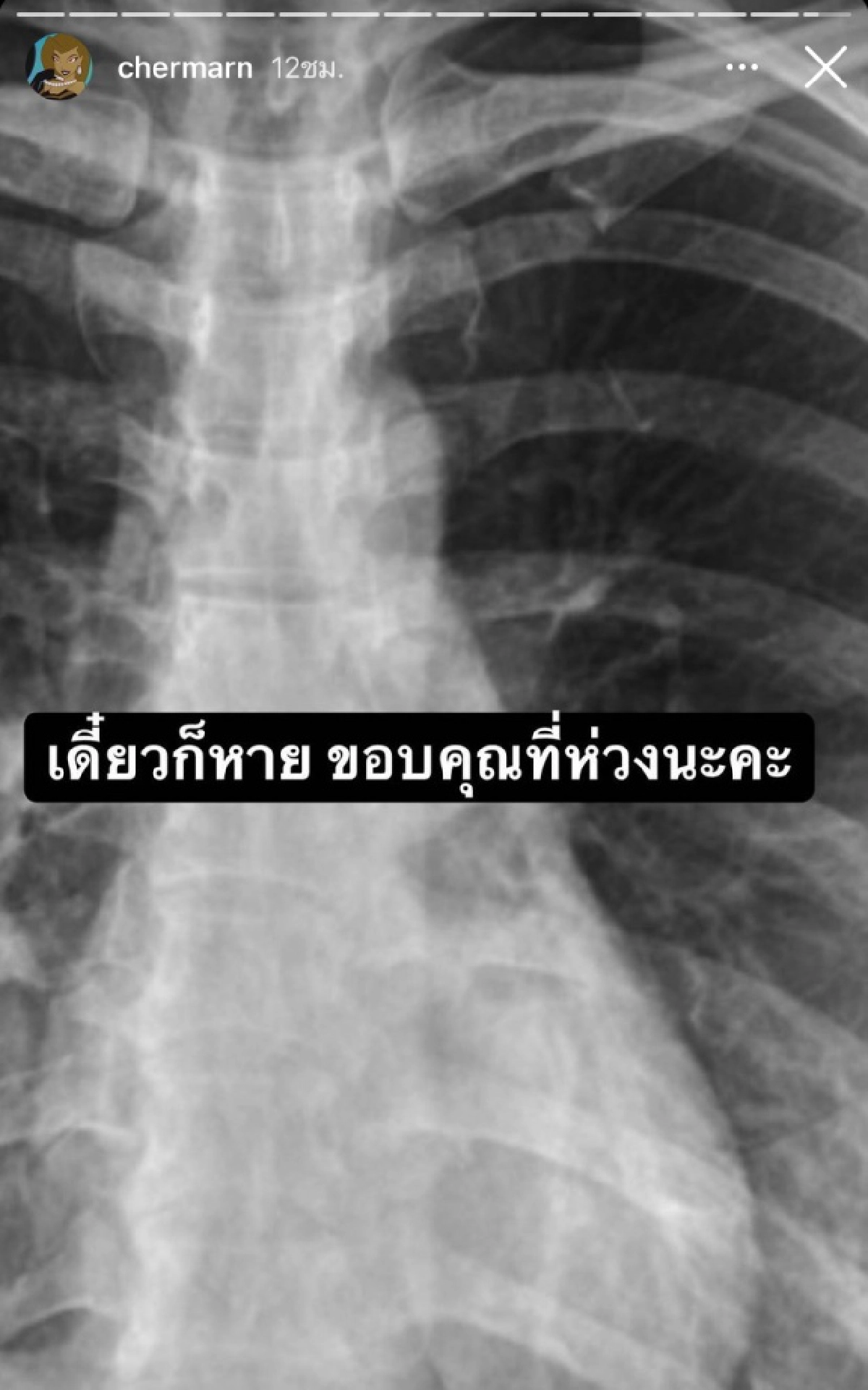 "พลอย เฌอมาลย์" เผยภาพฟิล์มเอ็กซ์เรย์ปอดพร้อมขอบคุณทุกความห่วงใย  