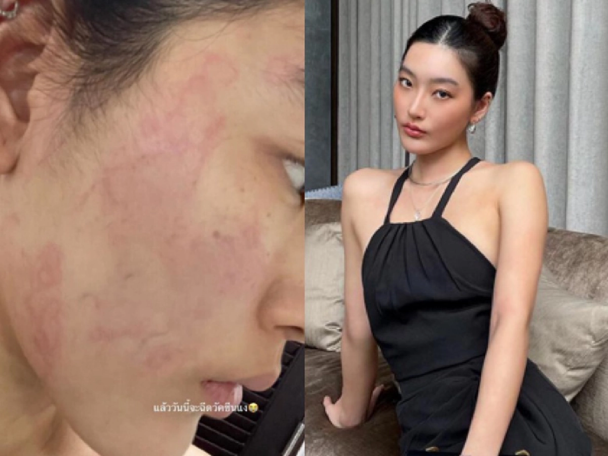 'สกุล กัญญาภัค'  ยังโอเคหลังฉีดวัคซีนขณะเป็นลมพิษ และมีโรคประจำตัวลิ้นหัวใจรั่ว ภูมิแพ้ ไมเกรน