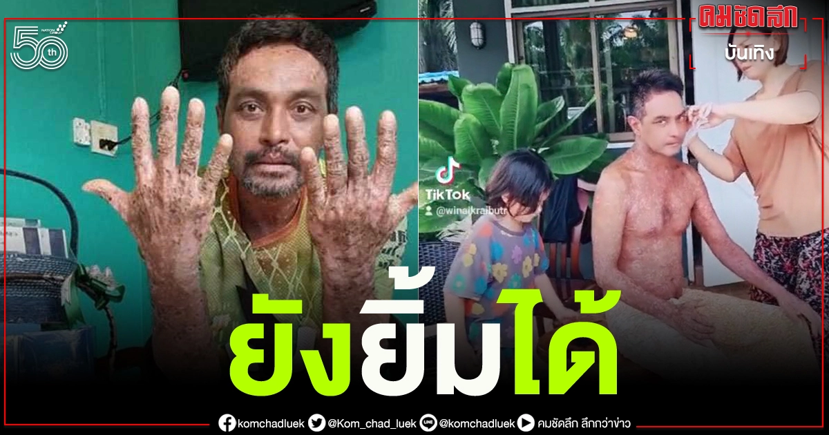 "วินัย ไกรบุตร" ยังยิ้มได้ แม้โรคตุ่มน้ำพองกำเริบ มีเมีย-ลูก เป็นกำลังใจ "วินัย ไกรบุตร" ยังยิ้มได้ แม้โรคตุ่มน้ำพองกำเริบ มีเมีย-ลูก เป็นกำลังใจ